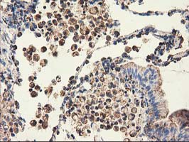 CLPP Antibody - IHC of paraffin-embedded Carcinoma of Human lung tissue using anti-CLPP mouse monoclonal antibody.