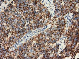 CLPP Antibody - IHC of paraffin-embedded Adenocarcinoma of Human ovary tissue using anti-CLPP mouse monoclonal antibody.