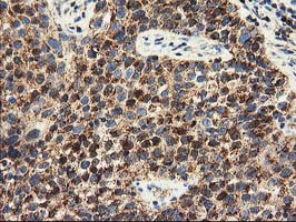 CLPP Antibody - IHC of paraffin-embedded Carcinoma of Human bladder tissue using anti-CLPP mouse monoclonal antibody.