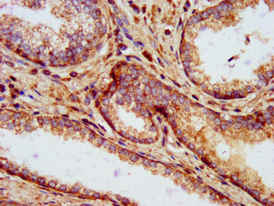 CLPP Antibody - Immunohistochemistry image at a dilution of 1:500 and staining in paraffin-embedded human prostate cancer performed on a Leica BondTM system. After dewaxing and hydration, antigen retrieval was mediated by high pressure in a citrate buffer (pH 6.0) . Section was blocked with 10% normal goat serum 30min at RT. Then primary antibody (1% BSA) was incubated at 4 °C overnight. The primary is detected by a biotinylated secondary antibody and visualized using an HRP conjugated SP system.