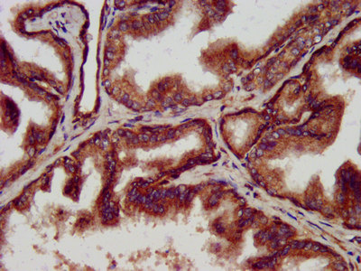 CLPP Antibody - Immunohistochemistry image at a dilution of 1:500 and staining in paraffin-embedded human prostate tissue performed on a Leica BondTM system. After dewaxing and hydration, antigen retrieval was mediated by high pressure in a citrate buffer (pH 6.0) . Section was blocked with 10% normal goat serum 30min at RT. Then primary antibody (1% BSA) was incubated at 4 °C overnight. The primary is detected by a biotinylated secondary antibody and visualized using an HRP conjugated SP system.