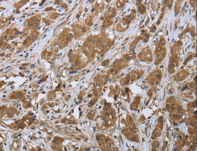 CLPS / Colipase Antibody - Immunohistochemistry of paraffin-embedded Human breast cancer using CLPS Polyclonal Antibody at dilution of 1:45.