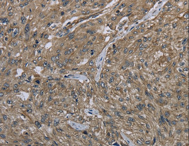 CLPS / Colipase Antibody - Immunohistochemistry of paraffin-embedded Human gastric cancer using CLPS Polyclonal Antibody at dilution of 1:40.
