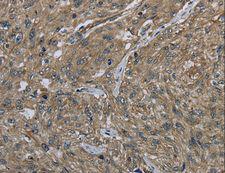 CLPS / Colipase Antibody - Immunohistochemistry of paraffin-embedded Human gastric cancer using CLPS Polyclonal Antibody at dilution of 1:40.
