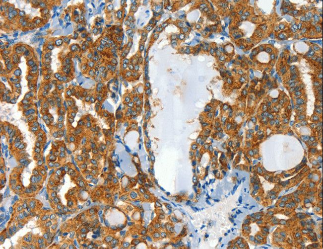 CLPTM1L / CLPTM1-Like Antibody - Immunohistochemistry of paraffin-embedded Human liver cancer using CLPTM1L Polyclonal Antibody at dilution of 1:60.