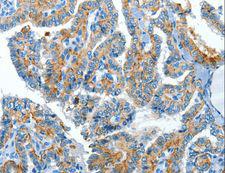 CLPTM1L / CLPTM1-Like Antibody - Immunohistochemistry of paraffin-embedded Human esophagus cancer using CLPTM1L Polyclonal Antibody at dilution of 1:60.
