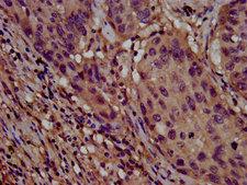 CLPTM1L / CLPTM1-Like Antibody - Immunohistochemistry image at a dilution of 1:800 and staining in paraffin-embedded human lung cancer performed on a Leica BondTM system. After dewaxing and hydration, antigen retrieval was mediated by high pressure in a citrate buffer (pH 6.0) . Section was blocked with 10% normal goat serum 30min at RT. Then primary antibody (1% BSA) was incubated at 4 °C overnight. The primary is detected by a biotinylated secondary antibody and visualized using an HRP conjugated SP system.