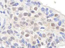 CLSPN / Claspin Antibody - Detection of Human Claspin by Immunohistochemistry. Sample: FFPE section of human lung carcinoma. Antibody: Affinity purified rabbit anti-Claspin used at a dilution of 1:1000 (1 Detection: DAB.