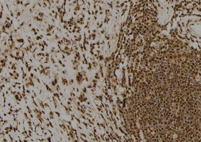 CLSPN / Claspin Antibody - 1:100 staining human gastric tissue by IHC-P. The sample was formaldehyde fixed and a heat mediated antigen retrieval step in citrate buffer was performed. The sample was then blocked and incubated with the antibody for 1.5 hours at 22°C. An HRP conjugated goat anti-rabbit antibody was used as the secondary.
