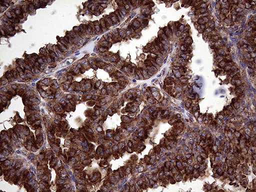 CLTA / LCA Antibody - Immunohistochemical staining of paraffin-embedded Carcinoma of Human thyroid tissue using anti-CLTA mouse monoclonal antibody. (Heat-induced epitope retrieval by 1mM EDTA in 10mM Tris buffer. (pH8.5) at 120°C for 3 min. (1:2000)