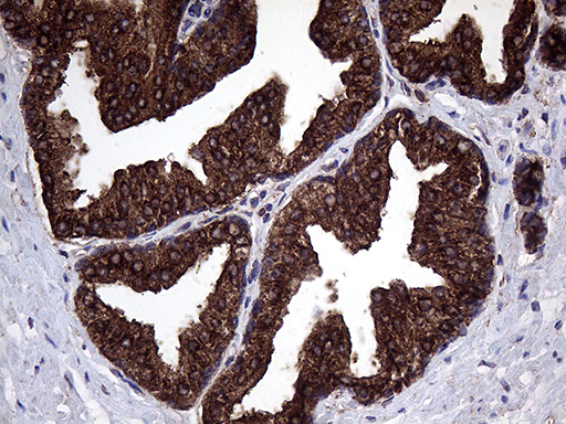 CLTA / LCA Antibody - Immunohistochemical staining of paraffin-embedded Carcinoma of Human prostate tissue using anti-CLTA mouse monoclonal antibody. (Heat-induced epitope retrieval by 1mM EDTA in 10mM Tris buffer. (pH8.5) at 120°C for 3 min. (1:2000)