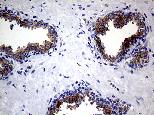CLTA / LCA Antibody - Immunohistochemical staining of paraffin-embedded Human prostate tissue within the normal limits using anti-CLTA mouse monoclonal antibody. (Heat-induced epitope retrieval by 1mM EDTA in 10mM Tris buffer. (pH8.5) at 120°C for 3 min. (1:500)