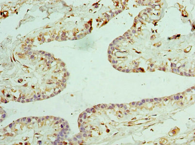 CLTA / LCA Antibody - Immunohistochemistry of paraffin-embedded human breast cancer at dilution 1:100