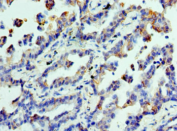 CLTA / LCA Antibody - Immunohistochemistry of paraffin-embedded human lung cancer at dilution 1:100