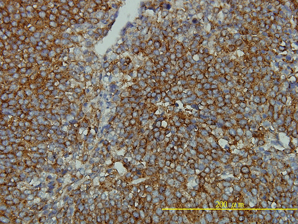CLTB Antibody - Immunoperoxidase of monoclonal antibody to CLTB on formalin-fixed paraffin-embedded human transitional cell carcinoma tissue. [antibody concentration 2 ug/ml].