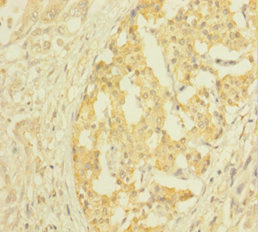 CLTB Antibody - Immunohistochemistry of paraffin-embedded human pancreatic cancer using CLTB Antibody at dilution of 1:100