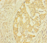 CLTB Antibody - Immunohistochemistry of paraffin-embedded human pancreatic cancer using CLTB Antibody at dilution of 1:100