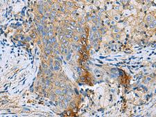 CLTB Antibody - Immunohistochemistry of paraffin-embedded Human cervical cancer tissue  using CLTB Polyclonal Antibody at dilution of 1:70(×200)