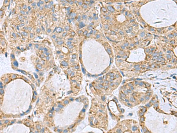 CLTB Antibody - Immunohistochemistry of paraffin-embedded Human thyroid cancer tissue  using CLTB Polyclonal Antibody at dilution of 1:70(×200)