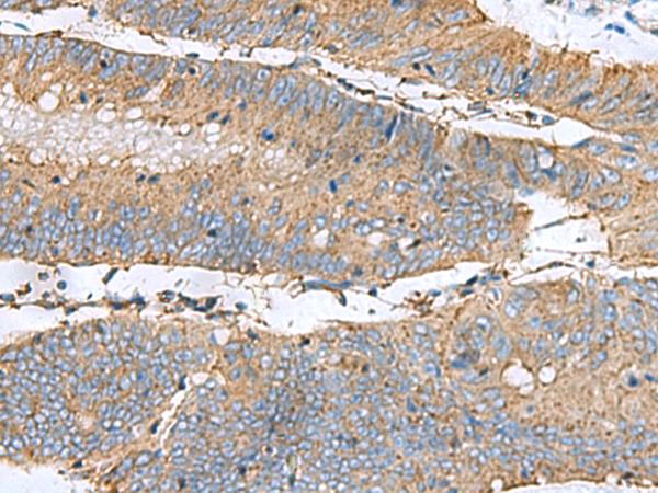 CLTB Antibody - Immunohistochemistry of paraffin-embedded Human colorectal cancer tissue  using CLTB Polyclonal Antibody at dilution of 1:60(×200)