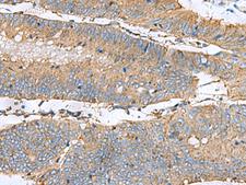 CLTB Antibody - Immunohistochemistry of paraffin-embedded Human colorectal cancer tissue  using CLTB Polyclonal Antibody at dilution of 1:60(×200)