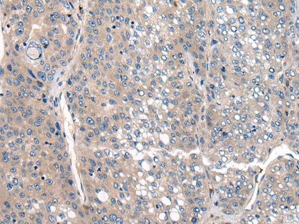 CLTCL1 / CHC22 Antibody - Immunohistochemistry of paraffin-embedded Human liver cancer tissue  using CLTCL1 Polyclonal Antibody at dilution of 1:60(×200)