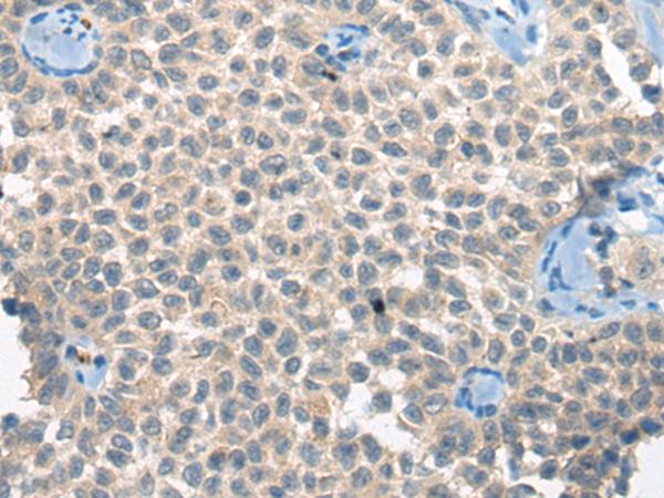 CLTCL1 / CHC22 Antibody - Immunohistochemistry of paraffin-embedded Human ovarian cancer tissue  using CLTCL1 Polyclonal Antibody at dilution of 1:60(×200)