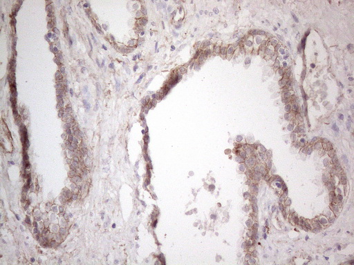 CLU / Clusterin Antibody - Immunohistochemical staining of paraffin-embedded Carcinoma of Human prostate tissue using anti-CLU mouse monoclonal antibody. (Heat-induced epitope retrieval by 1mM EDTA in 10mM Tris buffer. (pH8.5) at 120°C for 3 min. (1:150)