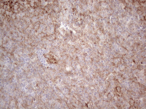 CLU / Clusterin Antibody - Immunohistochemical staining of paraffin-embedded Human lymphoma tissue using anti-CLU mouse monoclonal antibody. (Heat-induced epitope retrieval by 1mM EDTA in 10mM Tris buffer. (pH8.5) at 120°C for 3 min. (1:150)