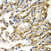 CLU / Clusterin Antibody - Immunohistochemistry of paraffin-embedded human lung cancer using CLU antibodyat dilution of 1:200 (40x lens).
