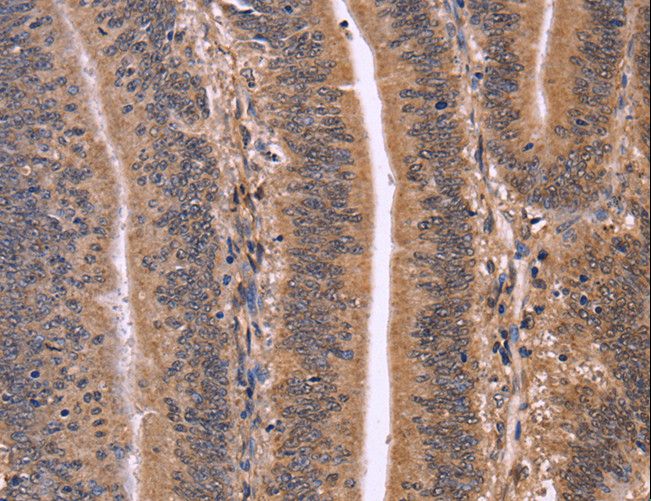 CLUAP1 Antibody - Immunohistochemistry of paraffin-embedded Human colon cancer using CLUAP1 Polyclonal Antibody at dilution of 1:50.