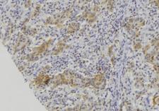 CMA1 / Mast Cell Chymase Antibody - 1:100 staining human lung carcinoma tissue by IHC-P. The sample was formaldehyde fixed and a heat mediated antigen retrieval step in citrate buffer was performed. The sample was then blocked and incubated with the antibody for 1.5 hours at 22°C. An HRP conjugated goat anti-rabbit antibody was used as the secondary.