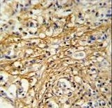 CMC2 / C16orf61 Antibody - DC13 Antibody IHC of formalin-fixed and paraffin-embedded human breast carcinoma followed by peroxidase-conjugated secondary antibody and DAB staining.