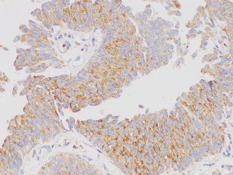 CML / BCR Antibody - Immunohistochemistry of paraffin-embedded Human bladder cancer using BCR Polycloanl Antibody at dilution of 1:200.