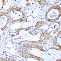 CML / BCR Antibody - Immunohistochemical analysis of BCR staining in human colon cancer formalin fixed paraffin embedded tissue section. The section was pre-treated using heat mediated antigen retrieval with sodium citrate buffer (pH 6.0). The section was then incubated with the antibody at room temperature and detected using an HRP-conjugated compact polymer system. DAB was used as the chromogen. The section was then counterstained with hematoxylin and mounted with DPX.