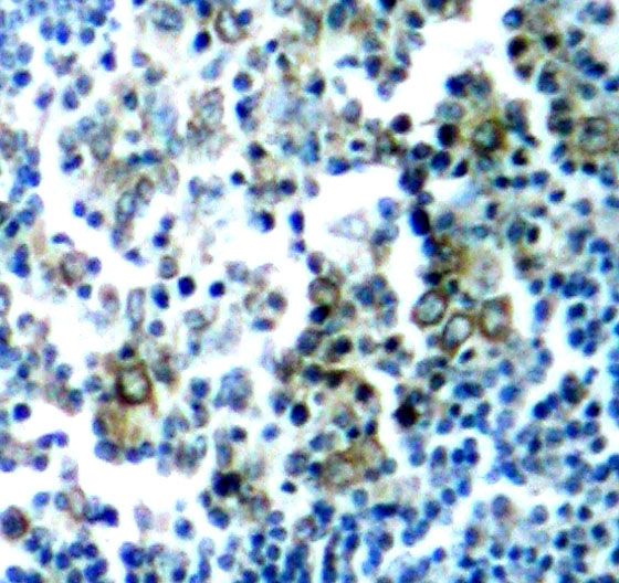 CML / BCR Antibody - Immunohistochemical analysis of paraffin-embedded human tonsil tumor tissue.