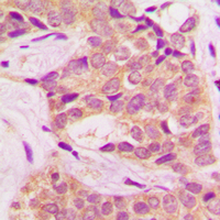 CML / BCR Antibody - Immunohistochemical analysis of BCR (pY360) staining in human breast cancer formalin fixed paraffin embedded tissue section. The section was pre-treated using heat mediated antigen retrieval with sodium citrate buffer (pH 6.0). The section was then incubated with the antibody at room temperature and detected using an HRP conjugated compact polymer system. DAB was used as the chromogen. The section was then counterstained with hematoxylin and mounted with DPX.