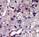 CMPK / CMPK1 Antibody - Formalin-fixed and paraffin-embedded human cancer tissue reacted with the primary antibody, which was peroxidase-conjugated to the secondary antibody, followed by AEC staining. This data demonstrates the use of this antibody for immunohistochemistry; clinical relevance has not been evaluated. BC = breast carcinoma; HC = hepatocarcinoma.