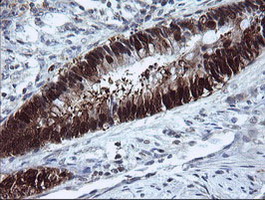 CMPK / CMPK1 Antibody - IHC of paraffin-embedded Adenocarcinoma of Human colon tissue using anti-CMPK1 mouse monoclonal antibody.