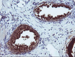 CMPK / CMPK1 Antibody - IHC of paraffin-embedded Carcinoma of Human prostate tissue using anti-CMPK1 mouse monoclonal antibody.
