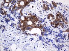 CMPK / CMPK1 Antibody - IHC of paraffin-embedded Adenocarcinoma of Human breast tissue using anti-CMPK1 mouse monoclonal antibody.