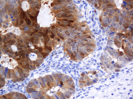 CMPK / CMPK1 Antibody - IHC of paraffin-embedded Adenocarcinoma of Human colon tissue using anti-CMPK1 mouse monoclonal antibody.