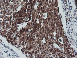 CMPK / CMPK1 Antibody - IHC of paraffin-embedded Carcinoma of Human bladder tissue using anti-CMPK1 mouse monoclonal antibody.