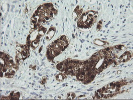 CMPK / CMPK1 Antibody - IHC of paraffin-embedded Carcinoma of Human prostate tissue using anti-CMPK1 mouse monoclonal antibody.