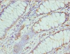 CMPK / CMPK1 Antibody - Immunohistochemistry of paraffin-embedded human colon cancer at dilution 1:100