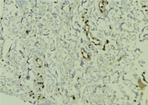 CMPK / CMPK1 Antibody - 1:100 staining human breast carcinoma tissue by IHC-P. The sample was formaldehyde fixed and a heat mediated antigen retrieval step in citrate buffer was performed. The sample was then blocked and incubated with the antibody for 1.5 hours at 22°C. An HRP conjugated goat anti-rabbit antibody was used as the secondary.