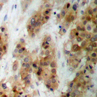 CMPK / CMPK1 Antibody - Immunohistochemical analysis of CMPK1 staining in human breast cancer formalin fixed paraffin embedded tissue section. The section was pre-treated using heat mediated antigen retrieval with sodium citrate buffer (pH 6.0). The section was then incubated with the antibody at room temperature and detected using an HRP conjugated compact polymer system. DAB was used as the chromogen. The section was then counterstained with hematoxylin and mounted with DPX.