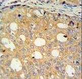 CMPK2 Antibody - CMPK2 Antibody IHC of formalin-fixed and paraffin-embedded human prostate carcinoma followed by peroxidase-conjugated secondary antibody and DAB staining.