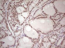 CMT2 / MAD2L1BP Antibody - Immunohistochemical staining of paraffin-embedded Carcinoma of Human thyroid tissue using anti-MAD2L1BP mouse monoclonal antibody. (Heat-induced epitope retrieval by 1 mM EDTA in 10mM Tris, pH8.5, 120C for 3min,