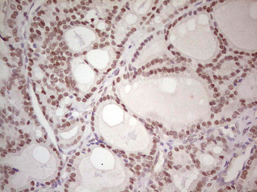 CMT2 / MAD2L1BP Antibody - IHC of paraffin-embedded Carcinoma of Human thyroid tissue using anti-MAD2L1BP mouse monoclonal antibody. (Heat-induced epitope retrieval by 1 mM EDTA in 10mM Tris, pH8.5, 120°C for 3min).